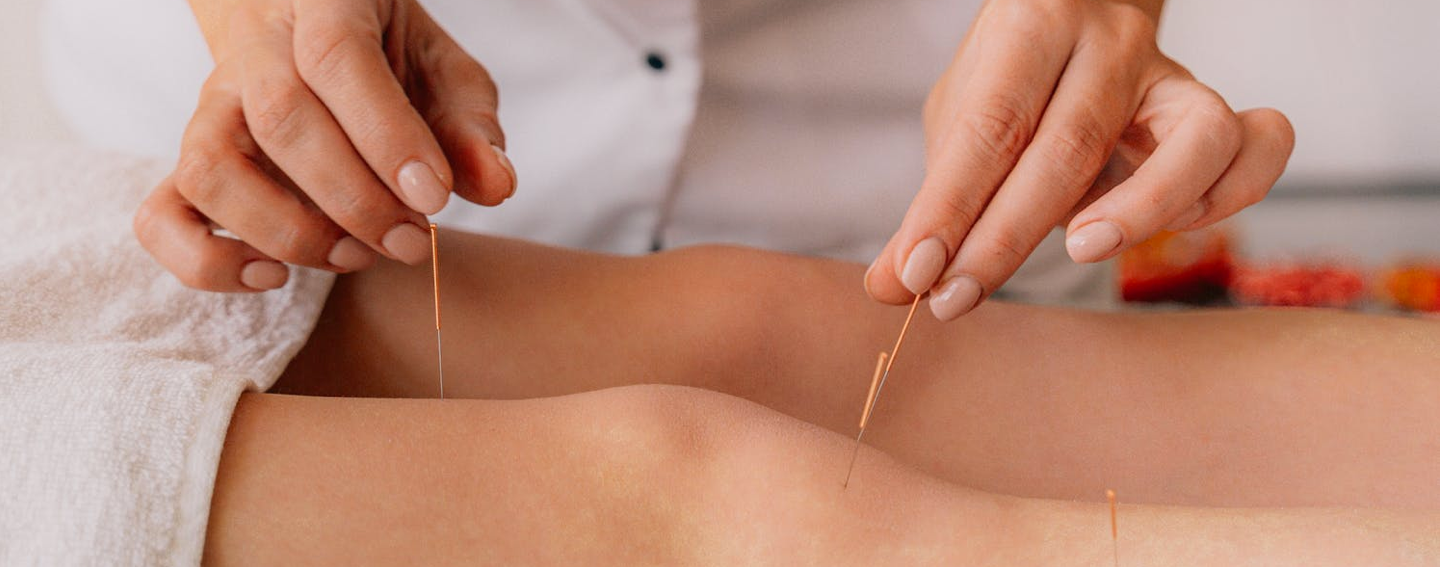 Patient receiving traditional acupuncture treatment